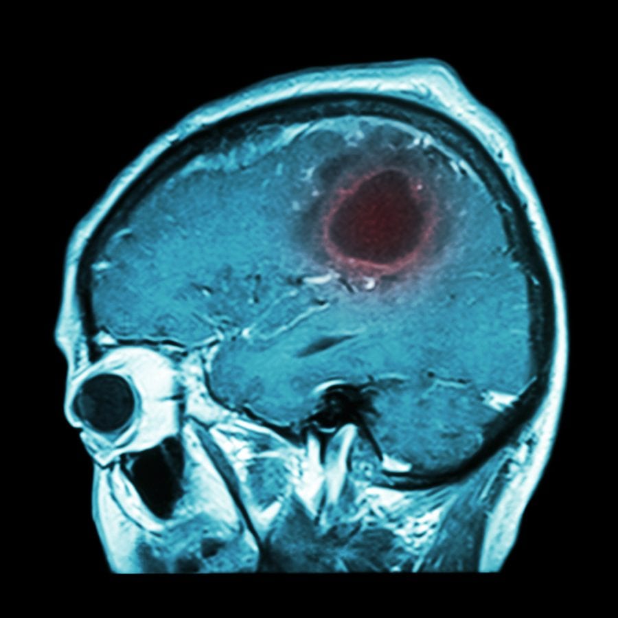 MRI showing brain tumor