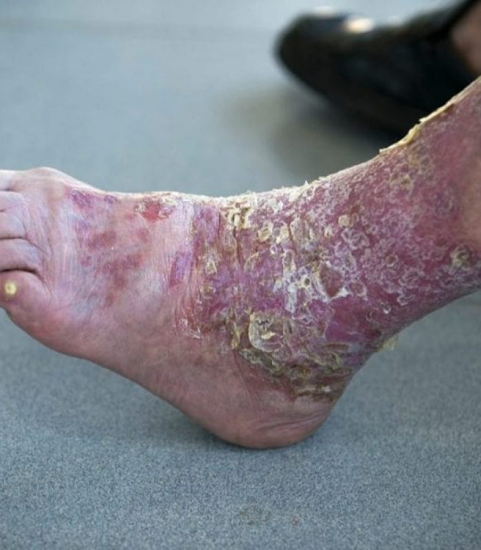 Can Psoriasis Be Helped by Cannabis?