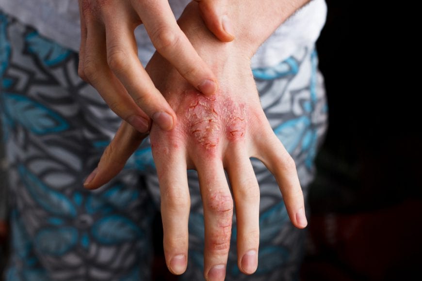 Young woman scratching psoriasis on her hand