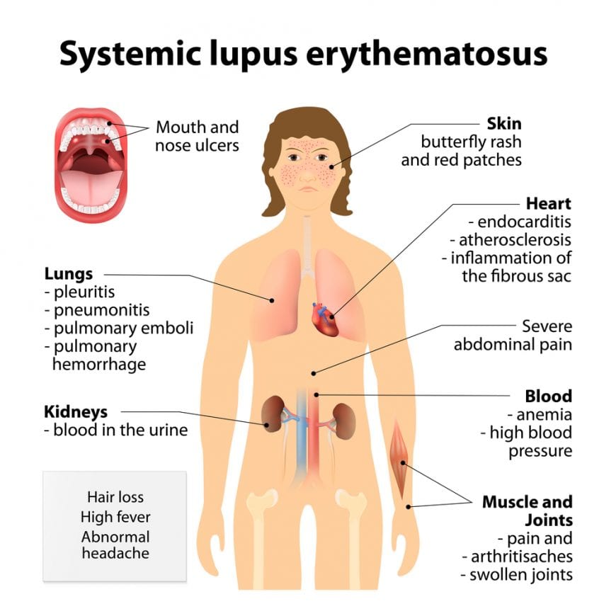 Animation showing organs affected by lupus