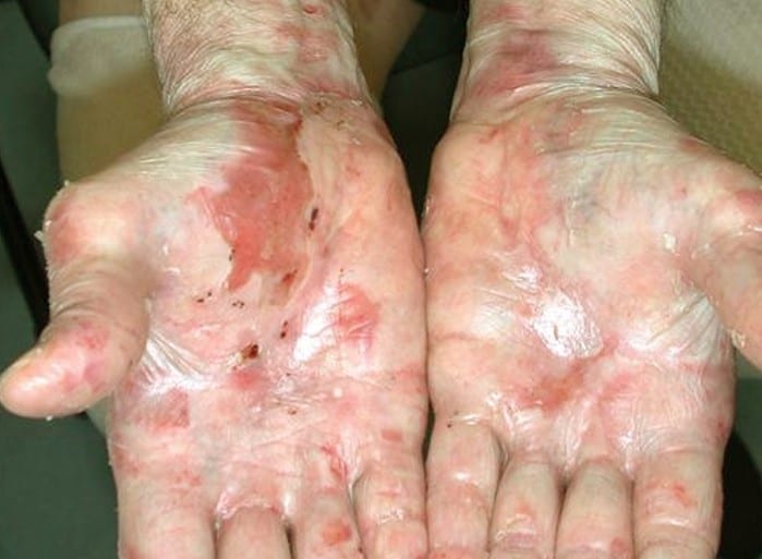 Epidermolysis Bullosa in the Hands