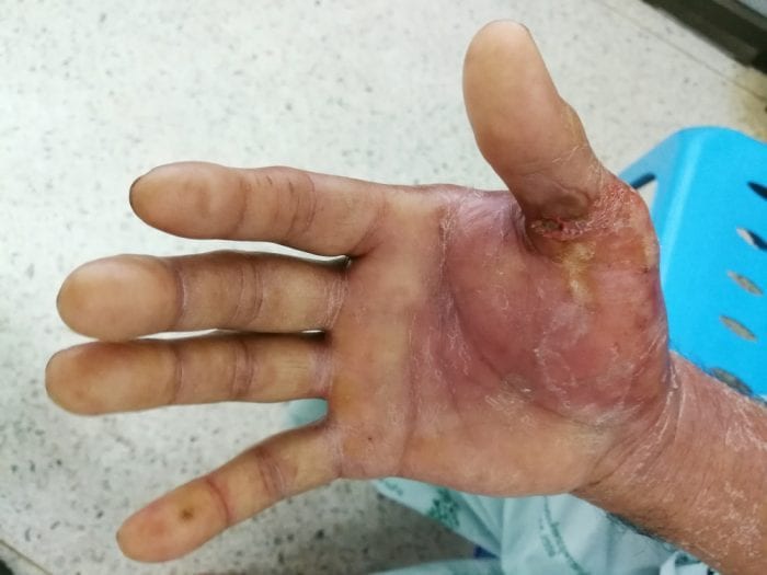 bacterial infection in human hand showing cellulitis