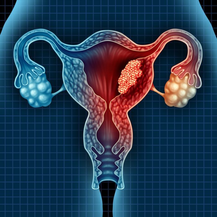 uterus, gyno, cancer, endometrial cancer, tumor, malignancy, endocannabinoid system, ECS