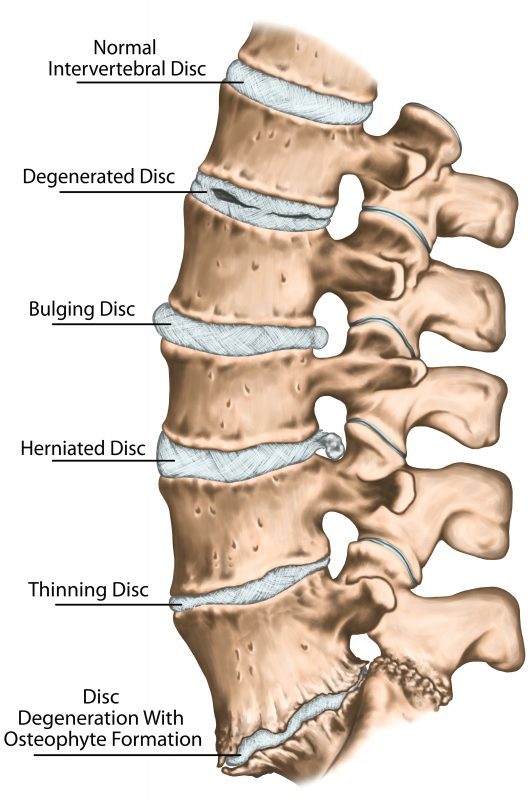 intervertebral disc damage graphic