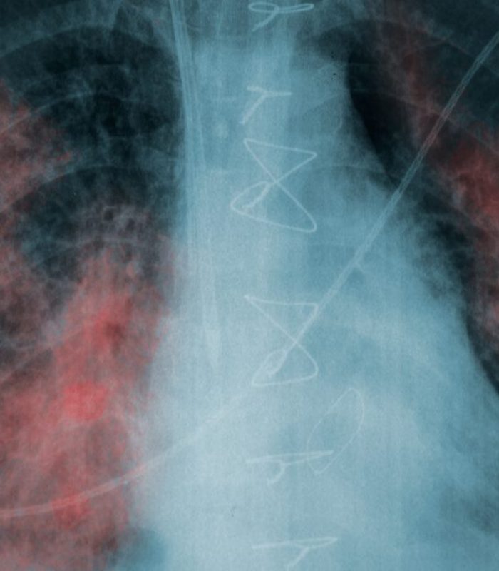 Lung Damage From Vaping: Why Is This Happening?
