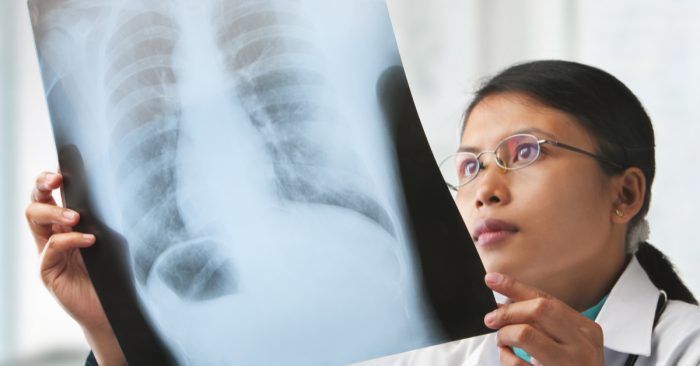 Study Finds CBD May Be Effective In Tumor Treatment